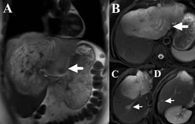 Sirolimus combined with interferon-alpha 2b therapy for giant hepatic epithelioid hemangioendothelioma: a case report